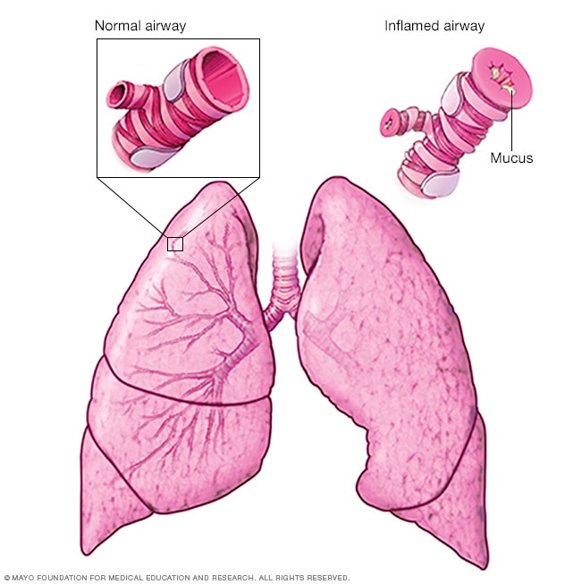 Asthma Mayo Clinic