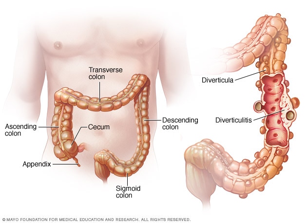 Diverticulitis Mayo Clinic