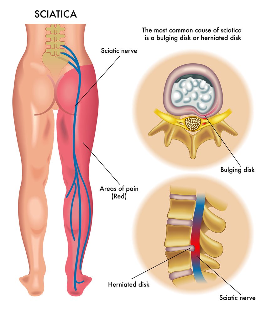 Cbd For Sciatica