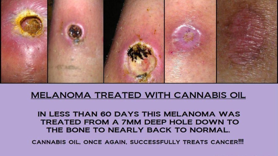 Cbd Oil And Skin Cancer