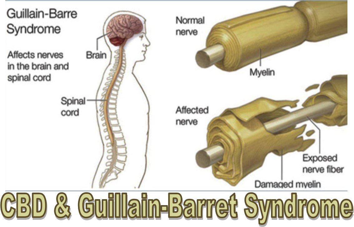 How Much Cbd Oil Do You Take For Guillain Barre