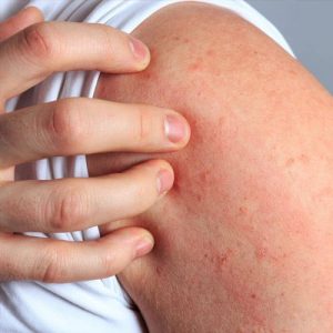 Rash From Cbd Oil