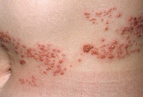 Skin Diseases Picture