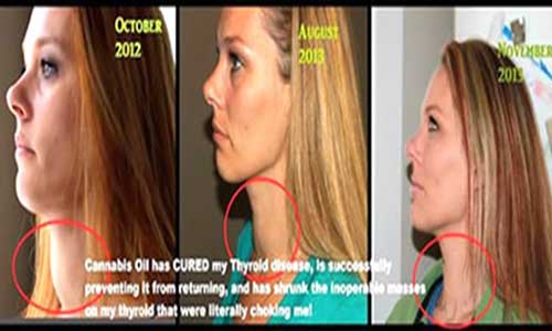 Cbd Oil And Thyroid Medication