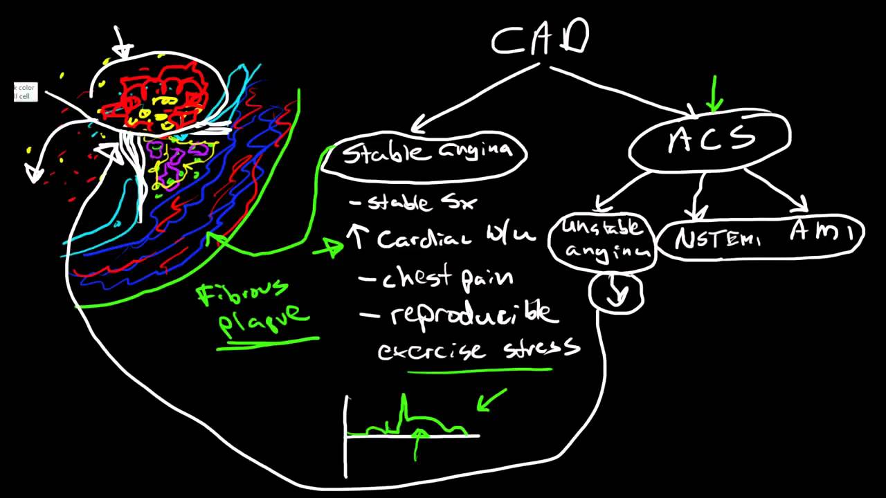 Coronary Artery Disease Pathophysiology