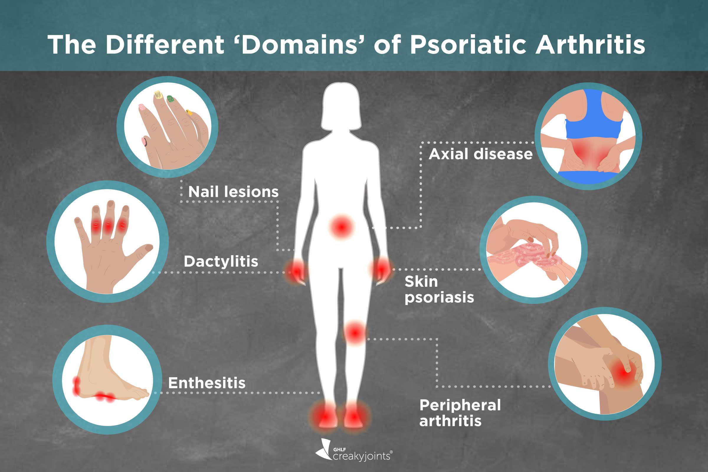 Peripheral Arthritis