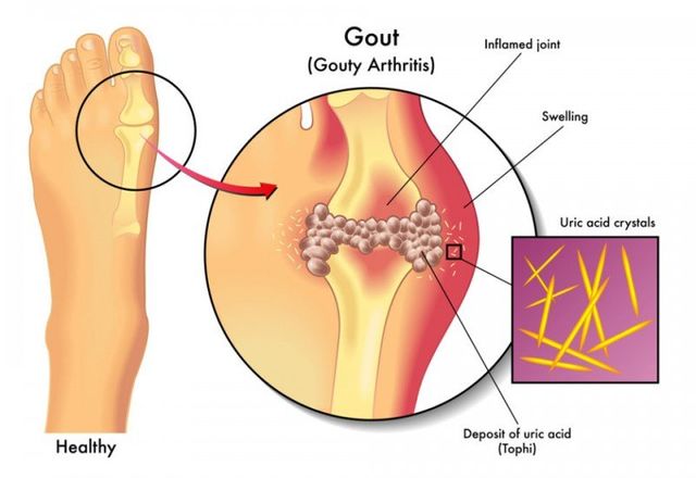 Cbd For Gout