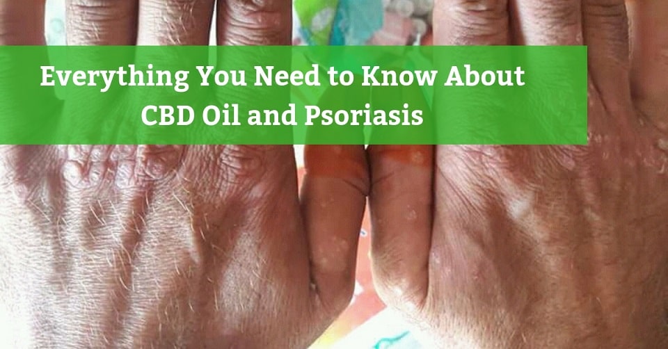 Cbd Oil Psoriasis Before And After