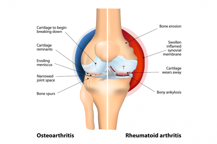 Definition Of Arthritis