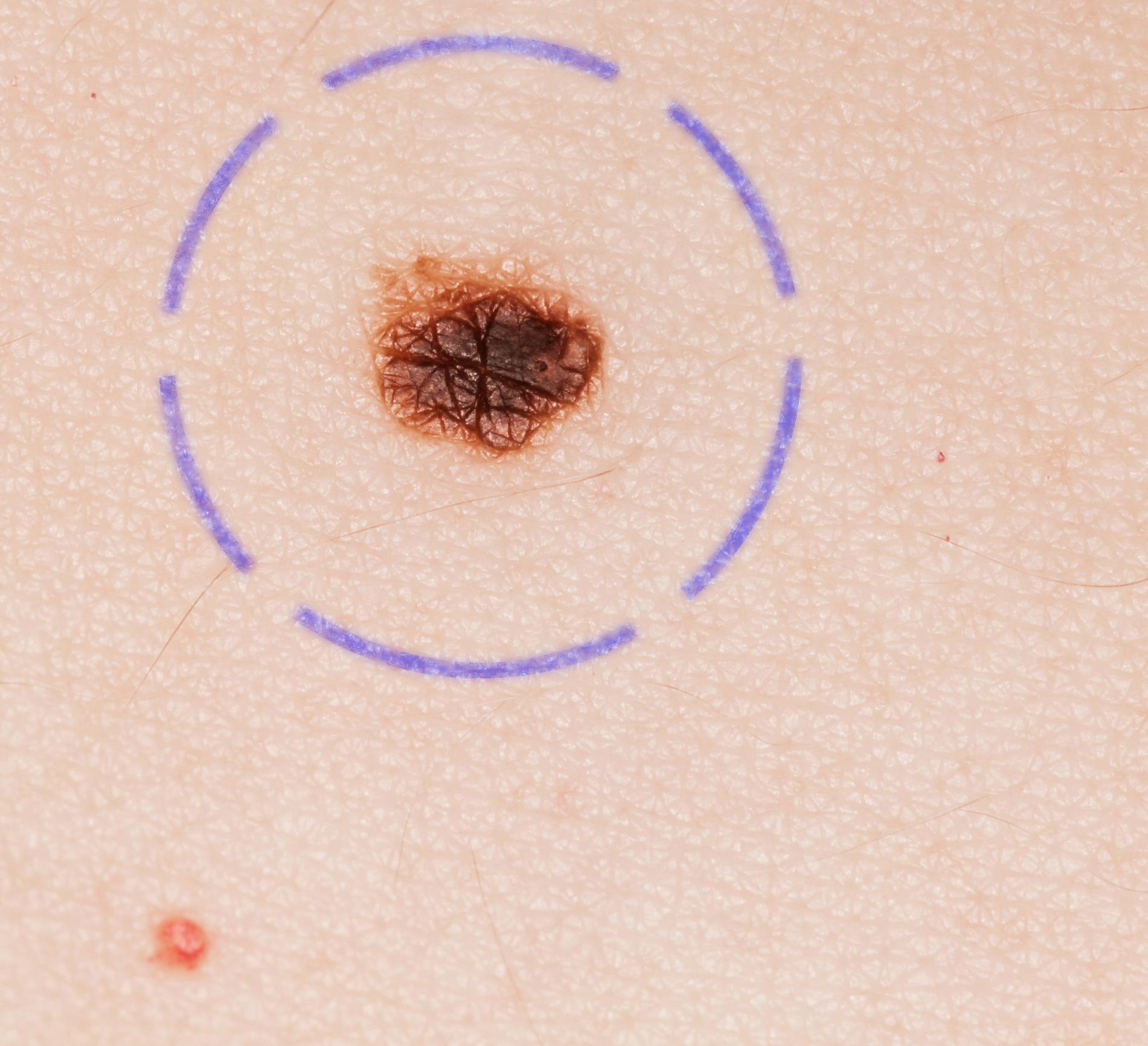 Skin Cancer Images Nhs