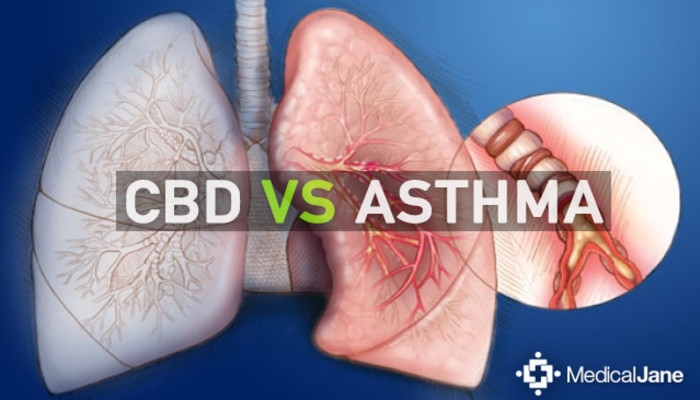 Cbd Asthma