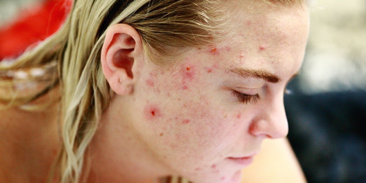 Cbd Oil And Acne