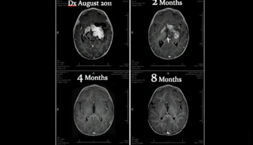 Cbd Oil Brain Tumor