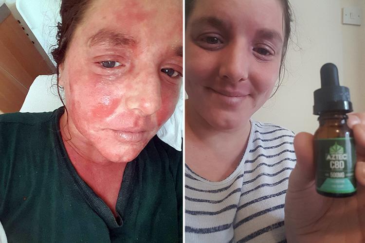 Cbd Oil Eczema