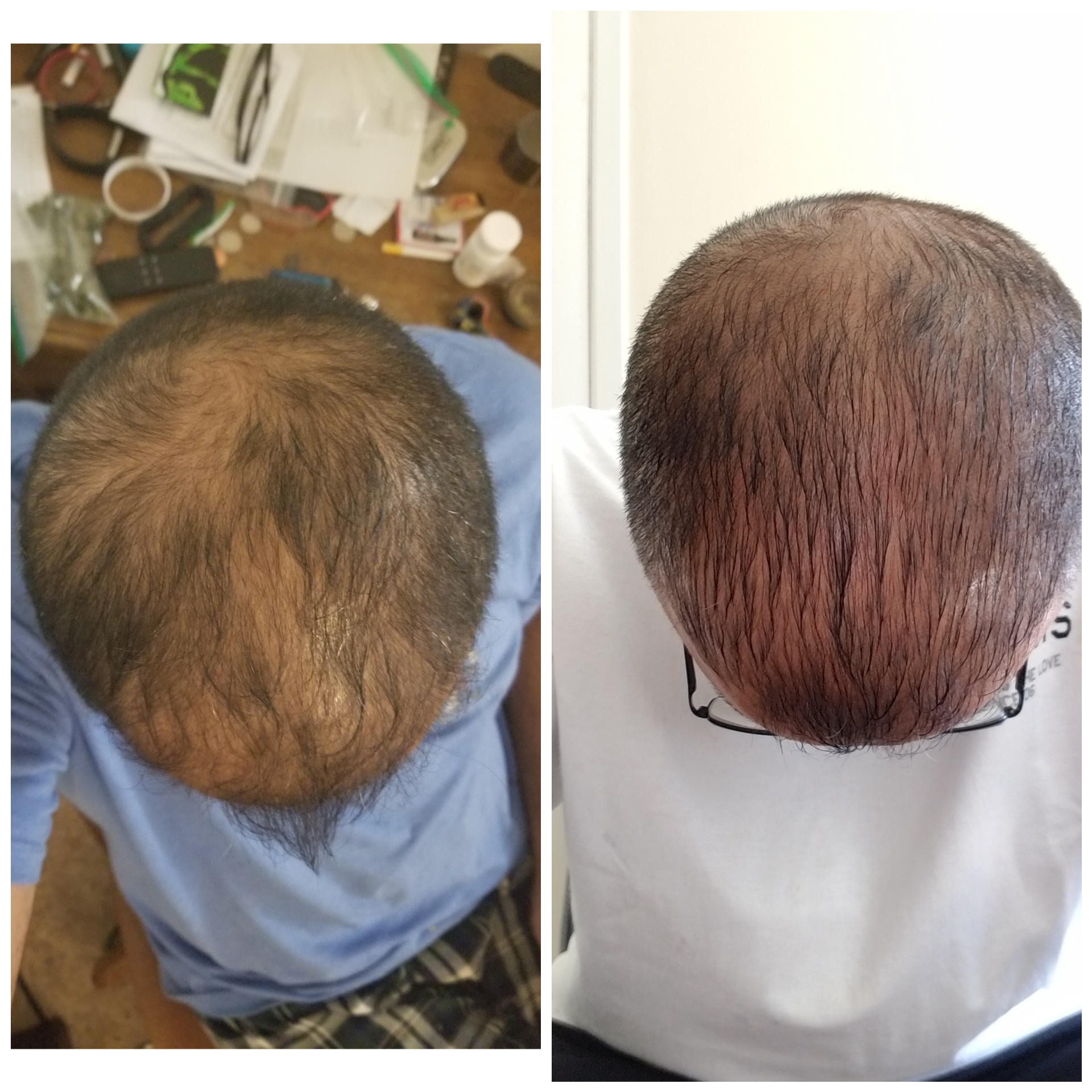 Cbd Oil Hair Growth