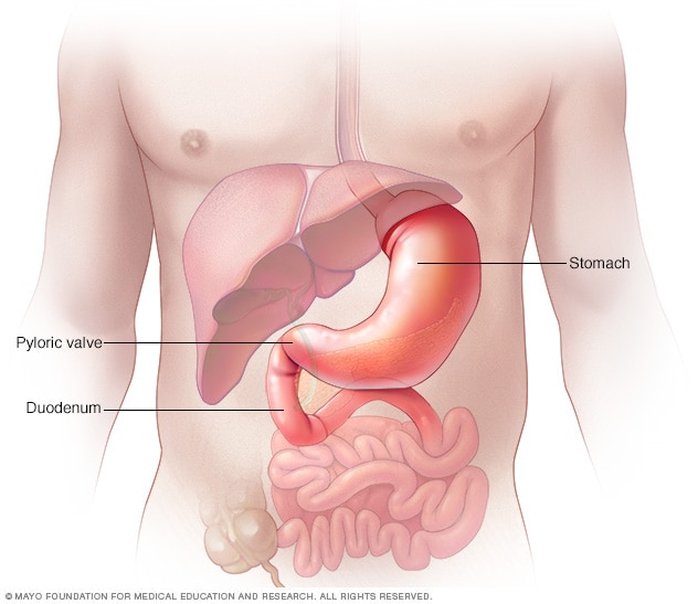 Gastritis Mayo Clinic